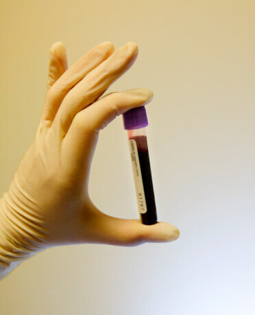 CBC Blood Work for Bone Health